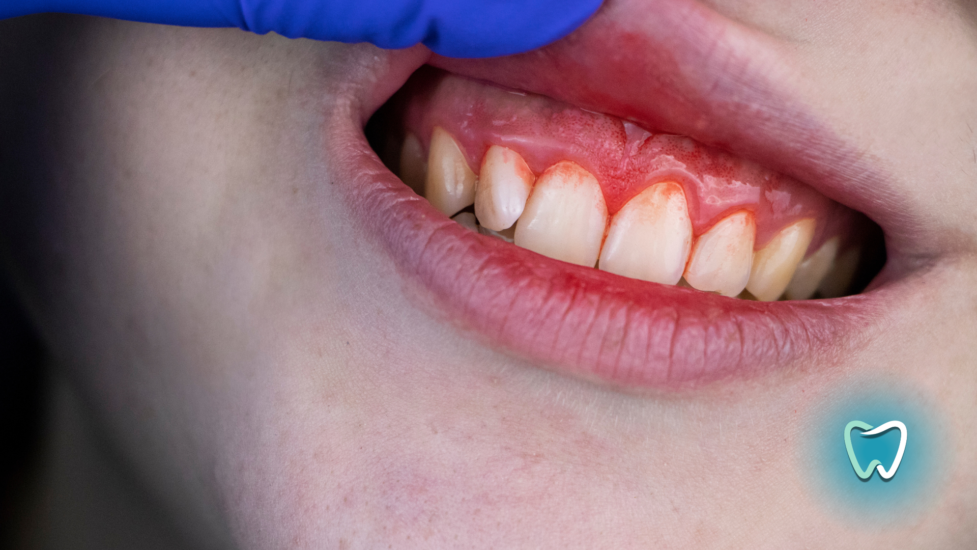 A close up of a person 's mouth with a tooth in the background.