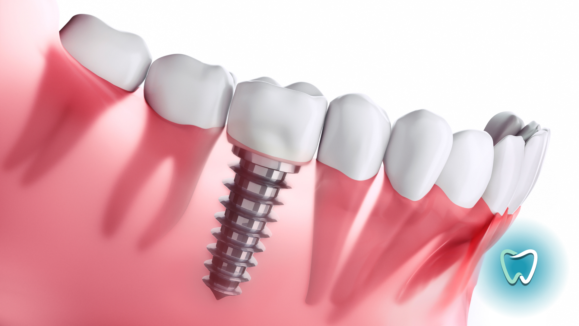 Tooth implant: metal screw in jawbone with new white tooth, surrounded by gums and other teeth.