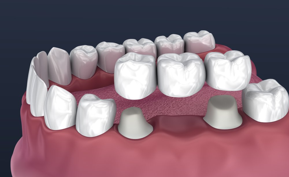 A computer generated image of a dental bridge in a mouth.