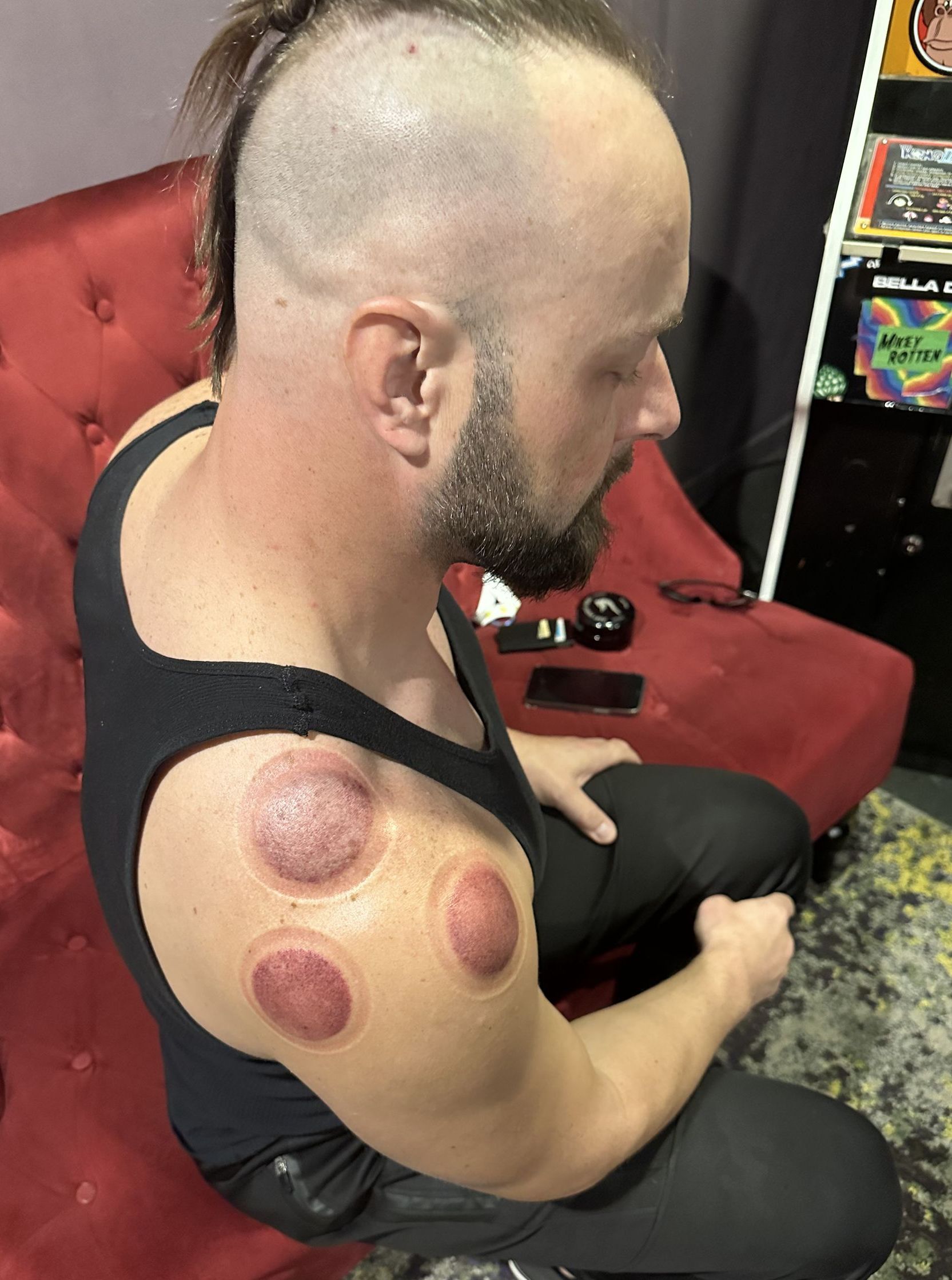 Adam Woloszyn a band member getting cupping therapy on his shoulder prior to performing. 