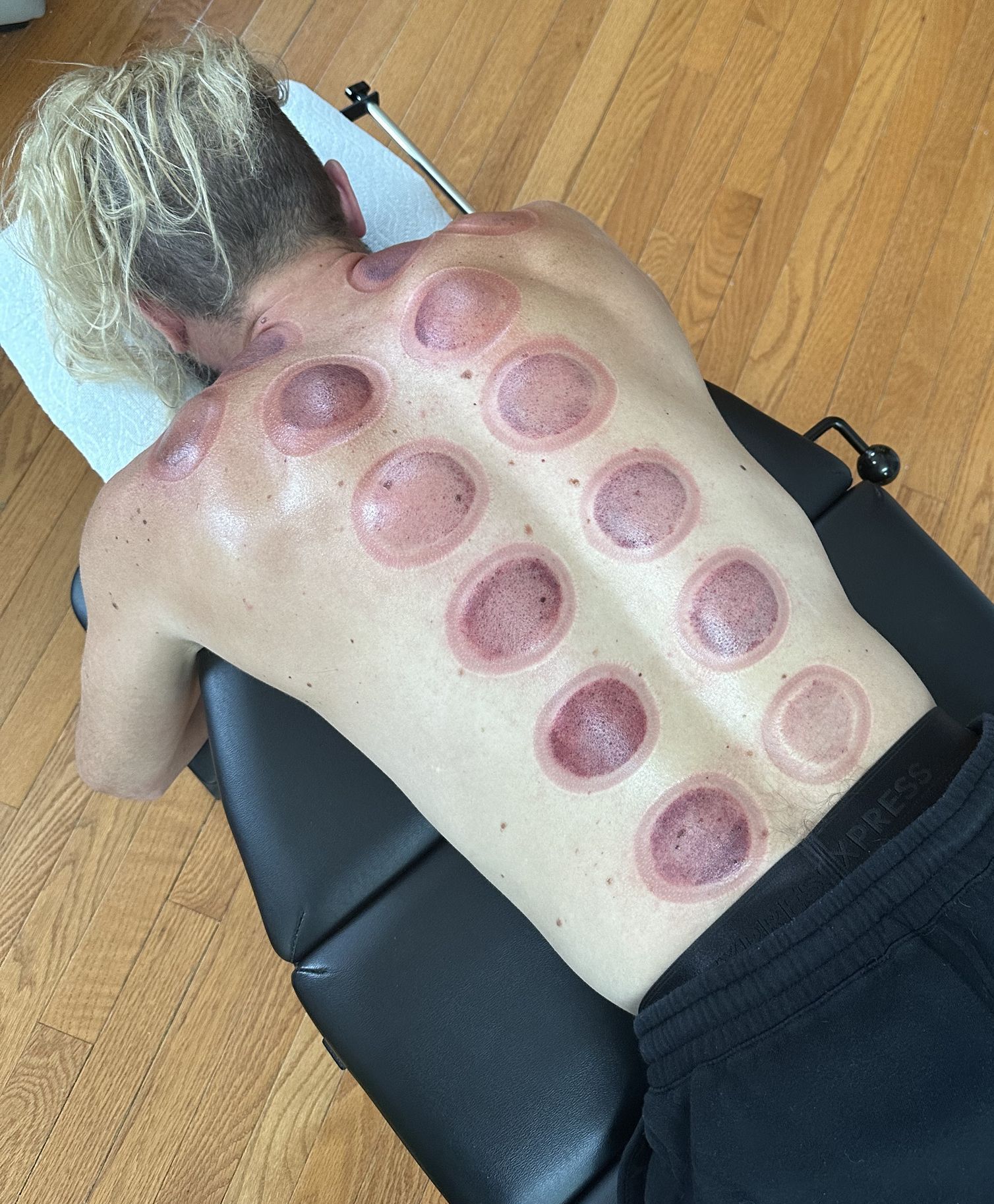 Pete Webber, drummer for a couple bands laying on a chiropractic table post cupping therapy in Colorado. 