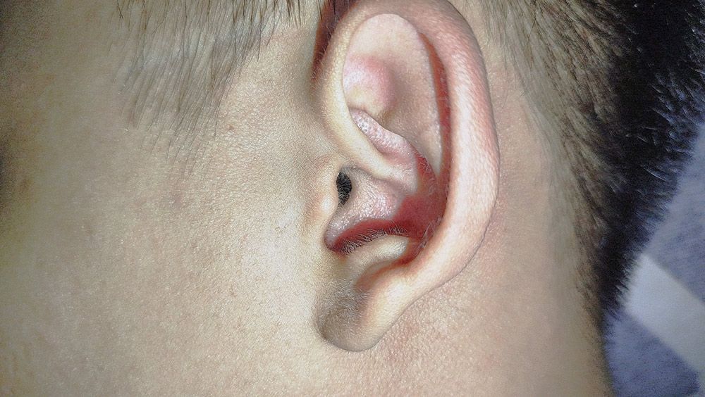 Close-Up of A Person's Ear, Pinkish Hue — Simply Clear Ear Care in Tinonee, NSW 