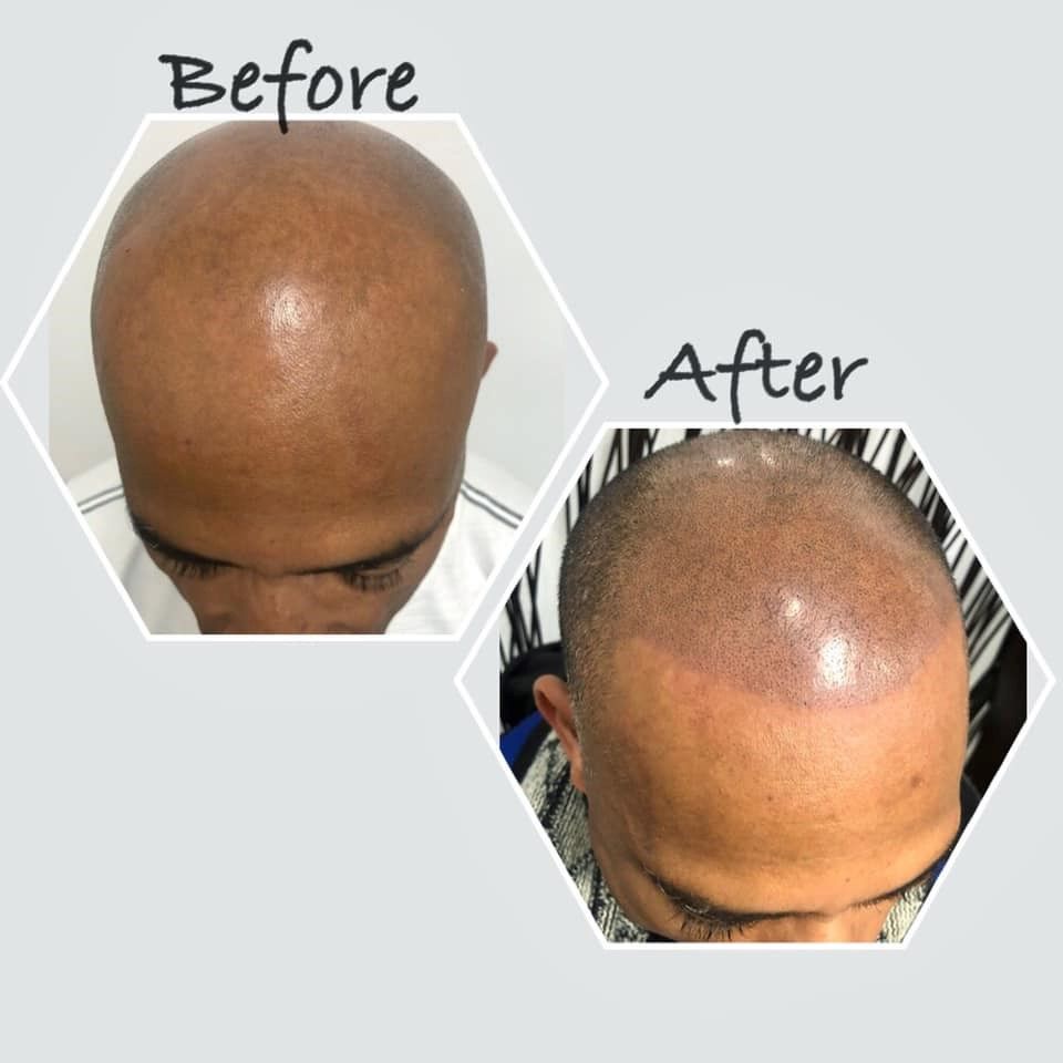 Before & After Scalp Micropigmentation Results – Mimiluxe Salon Montréal