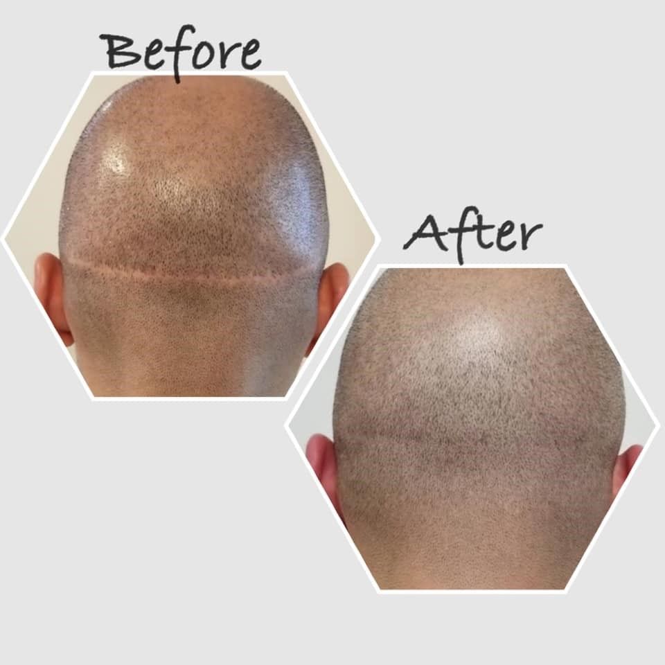 Visible Before & After SMP Hair Restoration – Mimiluxe Salon Montréal
