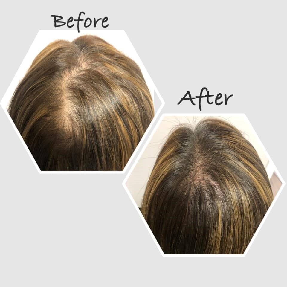 Before & After Hair Loss Treatment Results – Mimiluxe Salon Montréal