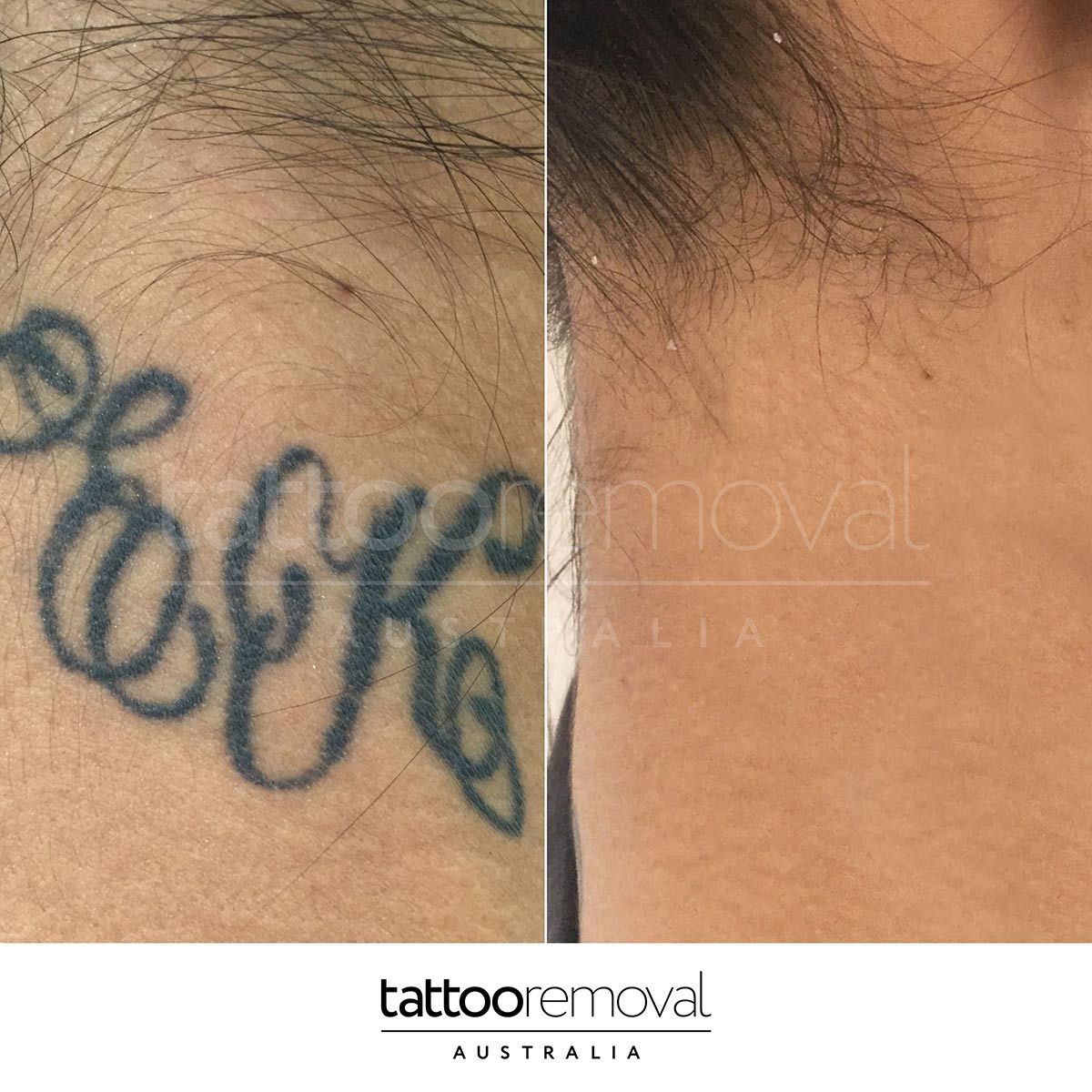 Woman's Neck Tattoo Removal — Laser Tattoo Removal Australia in Stone's Corner, QLD