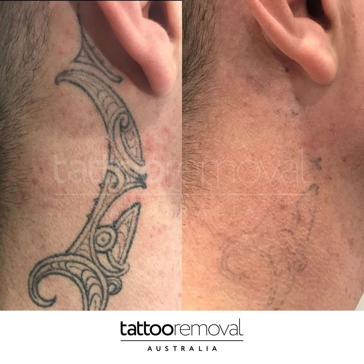 Side of Neck Tattoo Removal — Laser Tattoo Removal Australia in Stone's Corner, QLD