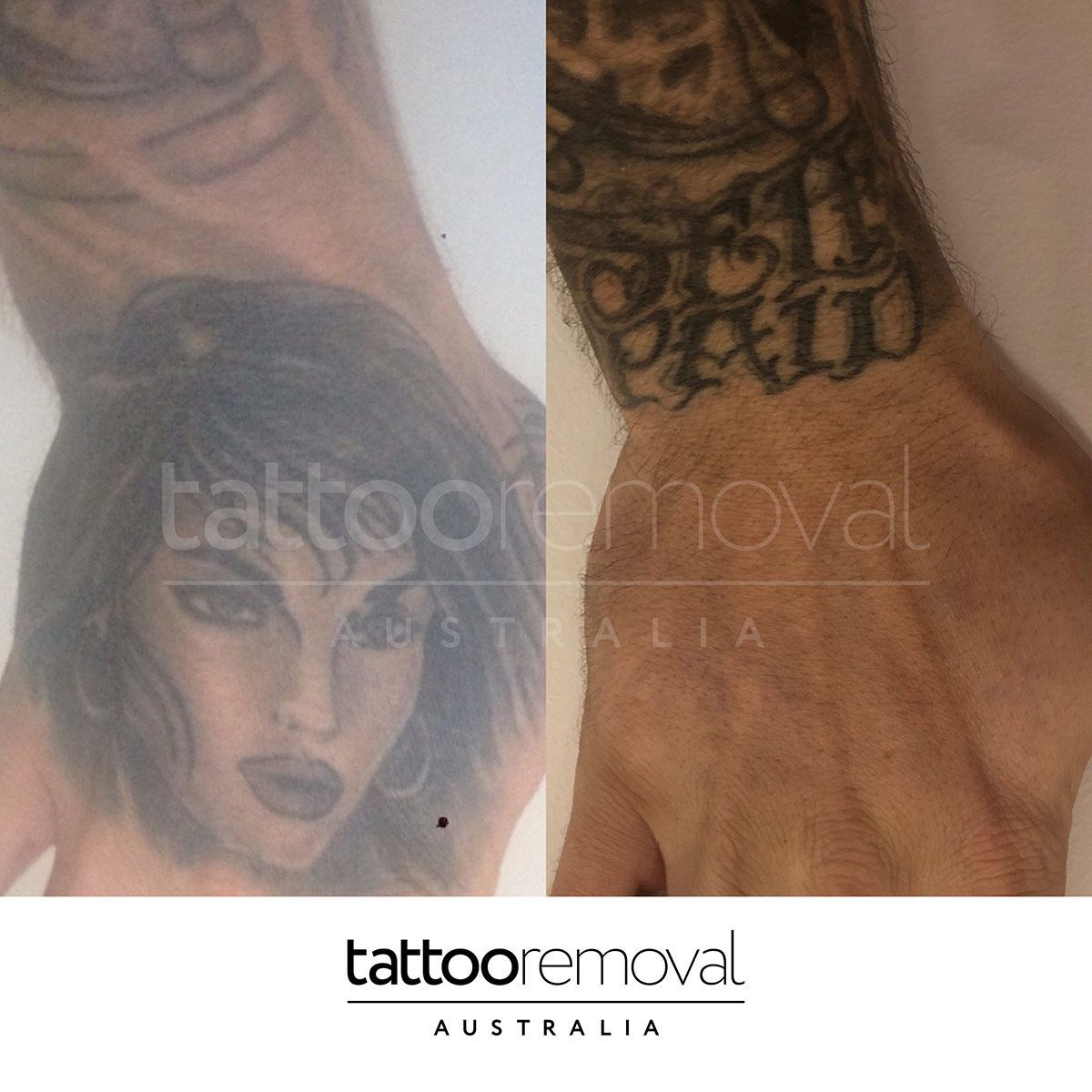 Hand Tattoo Removal — Laser Tattoo Removal Australia in Stone's Corner, QLD