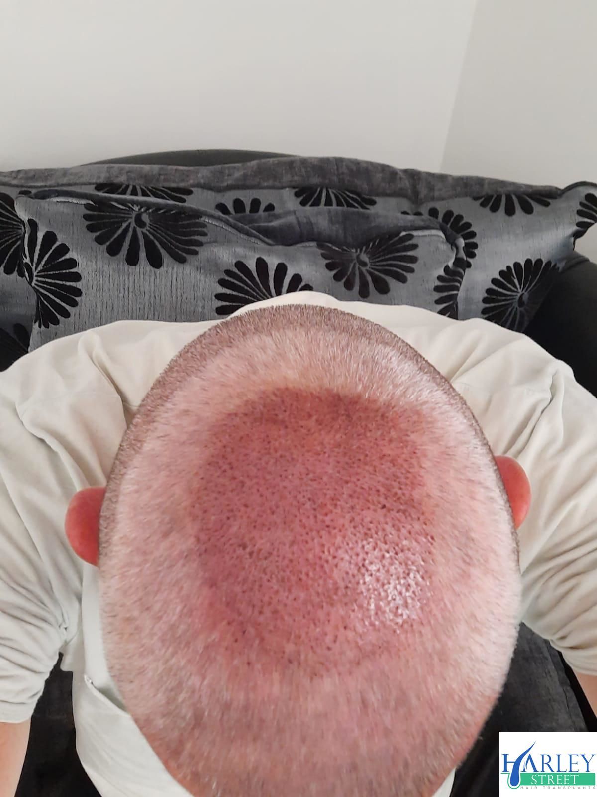 A picture of a patient with crown male pattern baldness