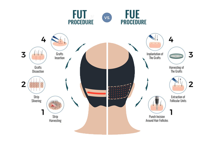 A schematic diagram showing the difference between FUE and FUT hair transplants