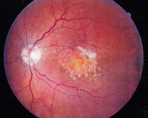 a close up of a person's retina with a few white spots on it from macular degeneration