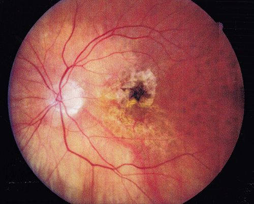 a close up of a person's retina with a black spot in the middle