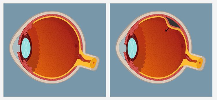 a diagram of a human eye showing a normal eye and a damaged eye .