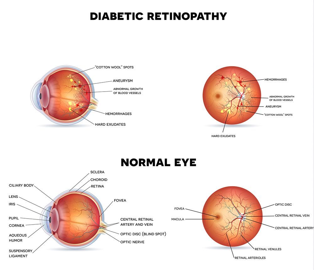 a diagram of a diabetic retinopathy and a normal eye