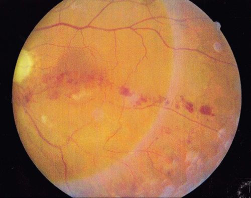a diagram of a diabetic retinopathy and a normal eye