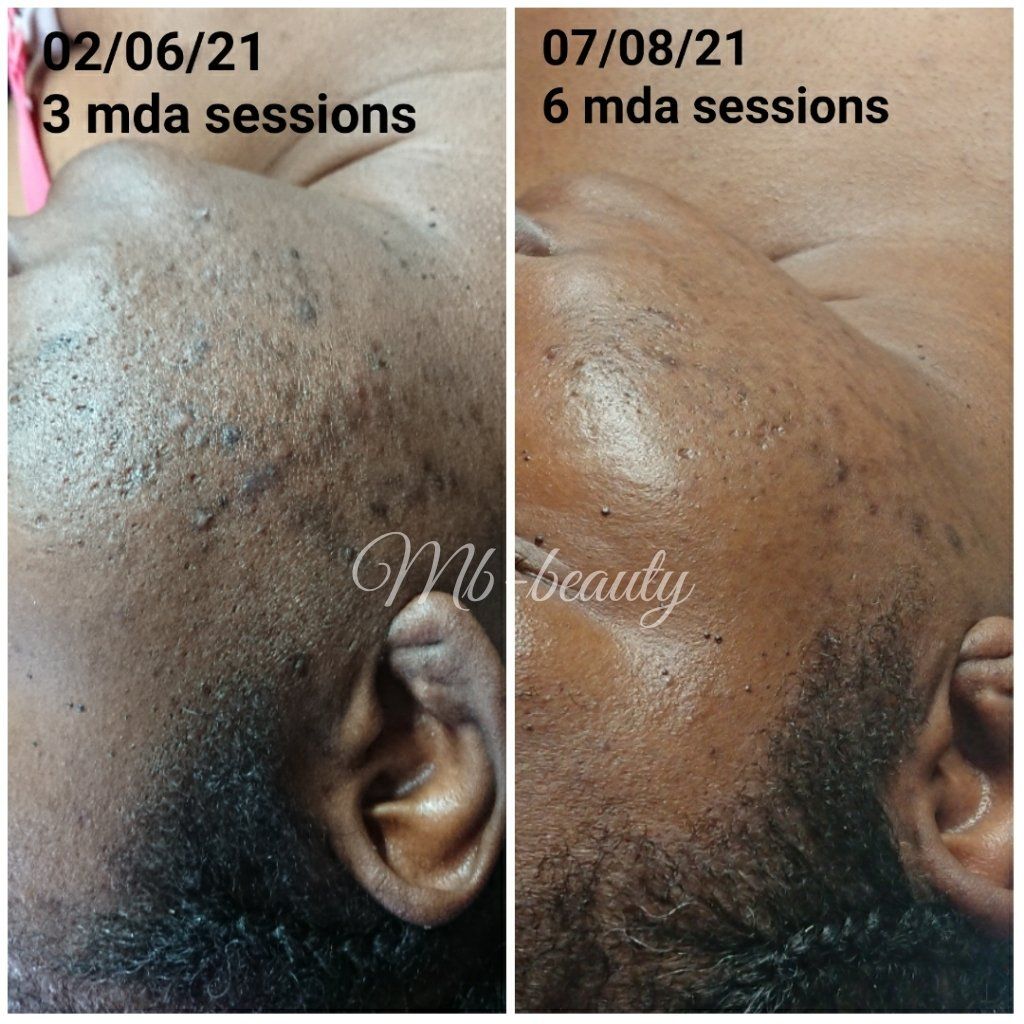 microdermabrasion