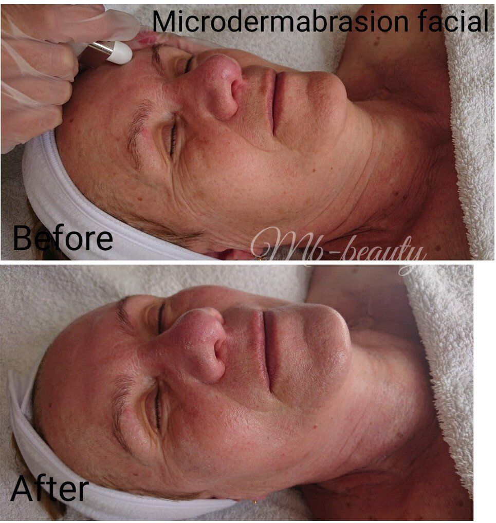 microdermabrasion