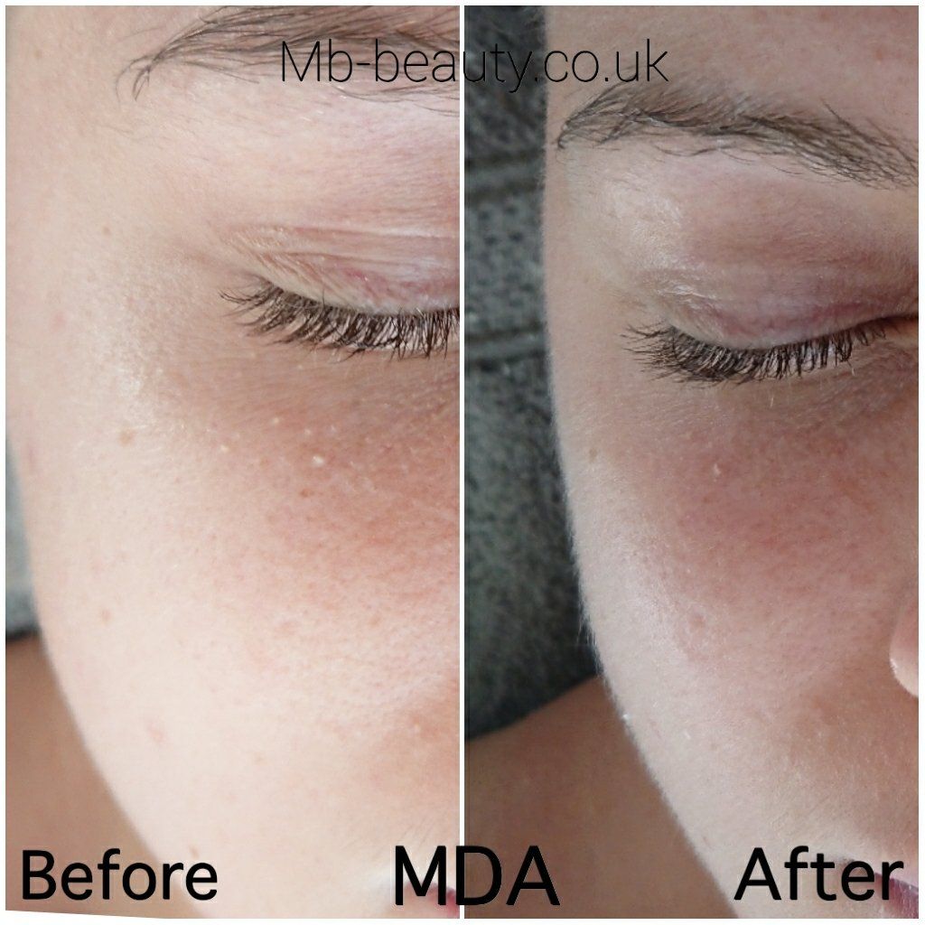 microdermabrasion Croydon