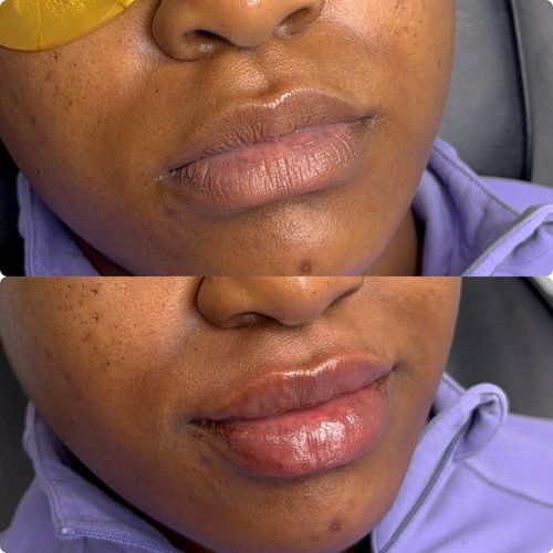 A before and after photo of a woman 's lips.