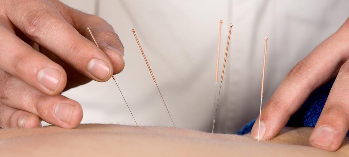 trattamenti con agopuntura