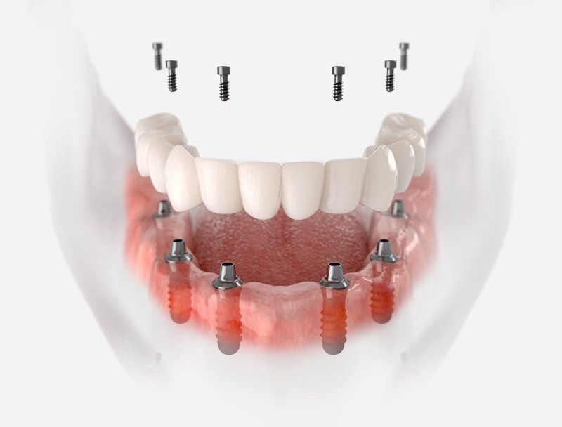 Dental Implants — Hattiesburg — Oral & Maxillofacial Surgery Center