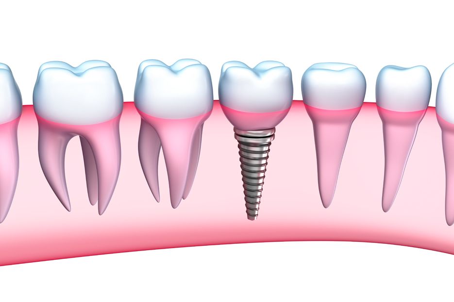 How to Find the Right Dental Implant Specialist