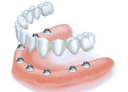 Multi-teeth and Full arch implants Saugus, MA