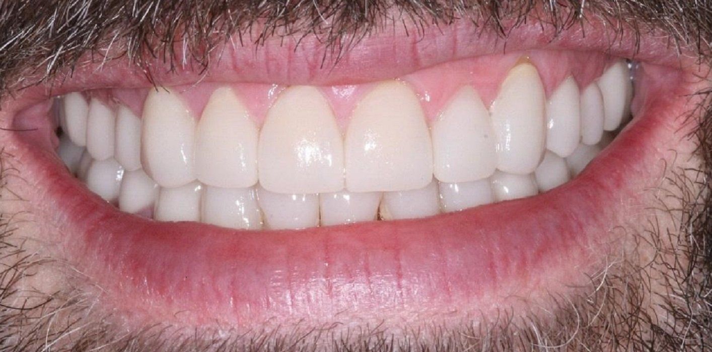 After full mouth rehad with crowns