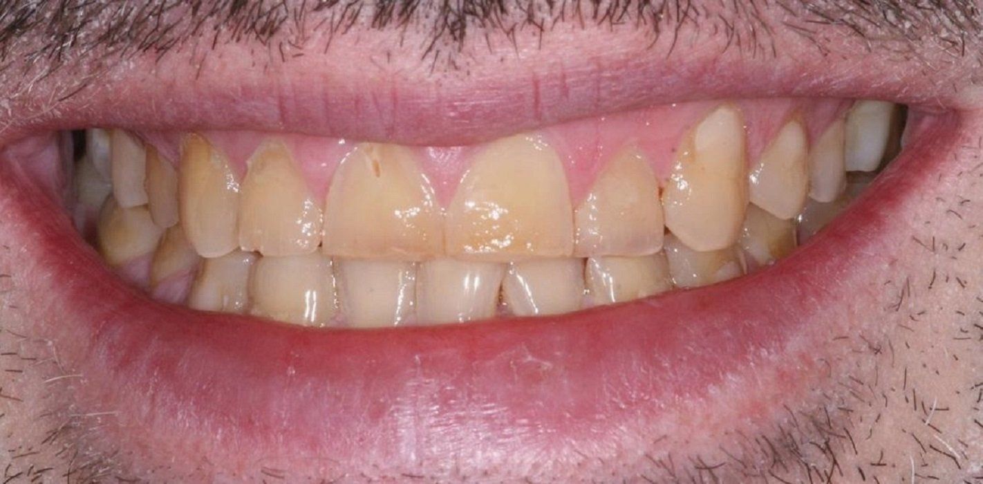 Before full mouth rehad with crowns