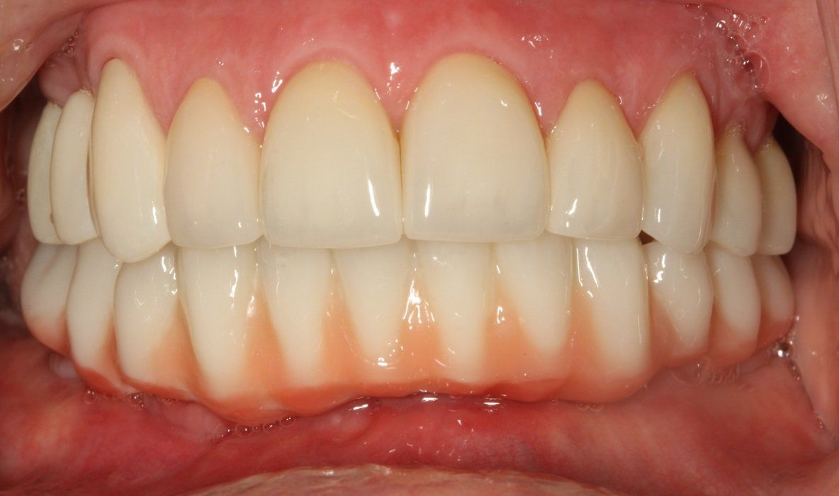 After crown and bridge on Upper teeth and all on six in lower