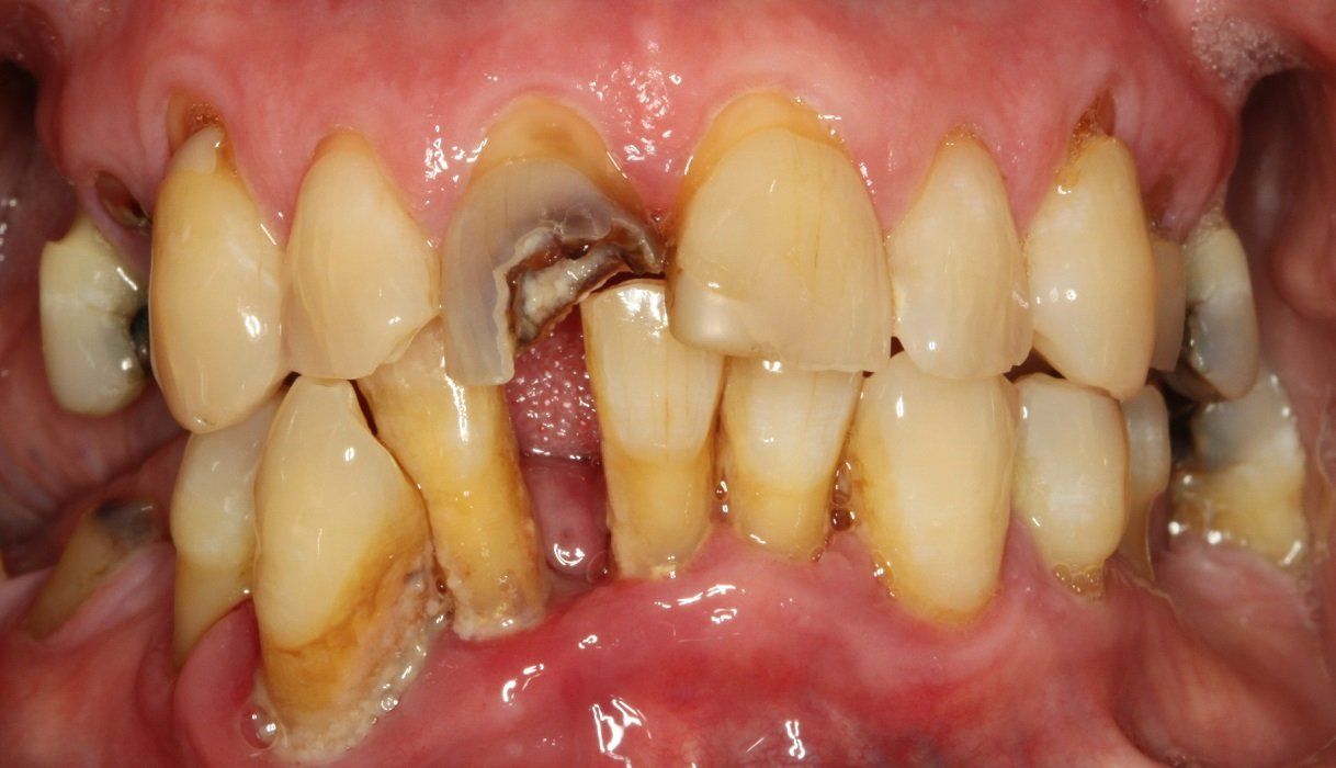 Before crown and bridge on Upper teeth and all on six in lower