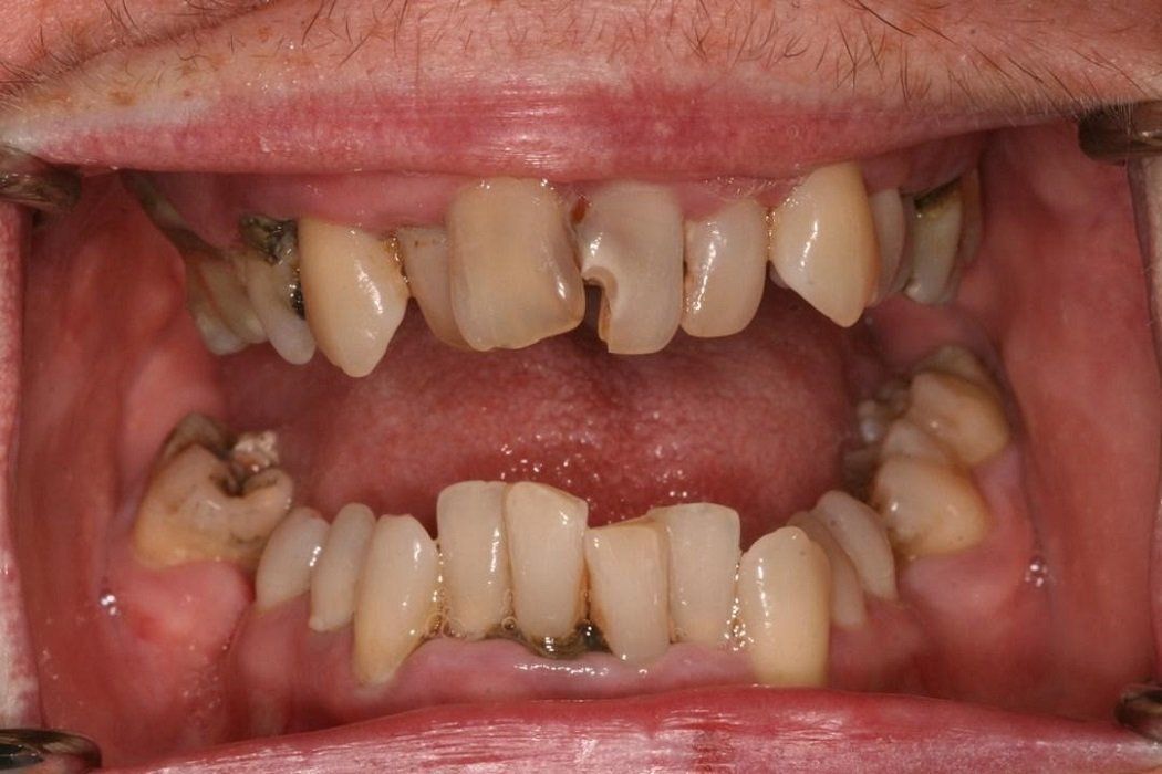Before full mouth rehab: Upper and Lower all on six