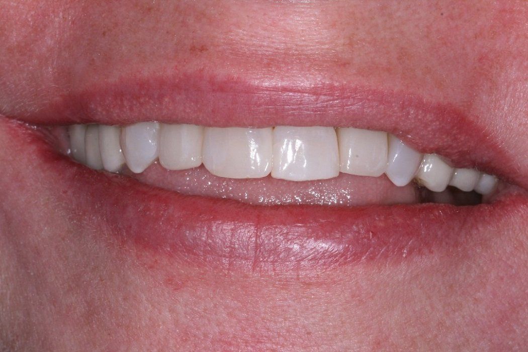 After Full ceramic crowns and veneers