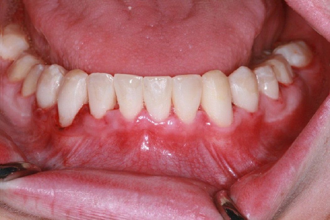 After Lower arch: Rampant Caries, Posits restoration
