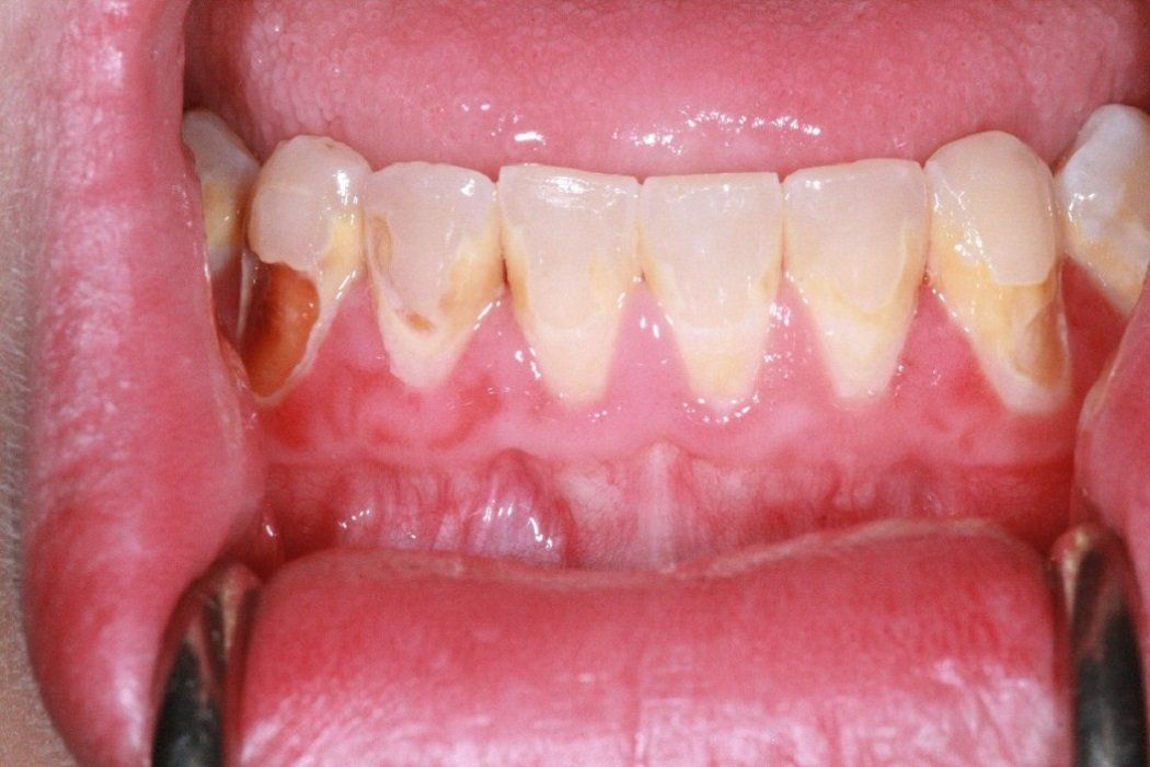 Before Lower arch: Rampant Caries, Posits restoration