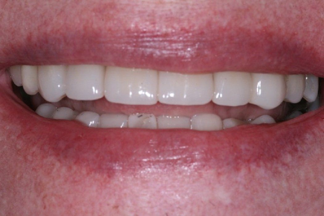 After full mouth rehad with crowns and veneers
