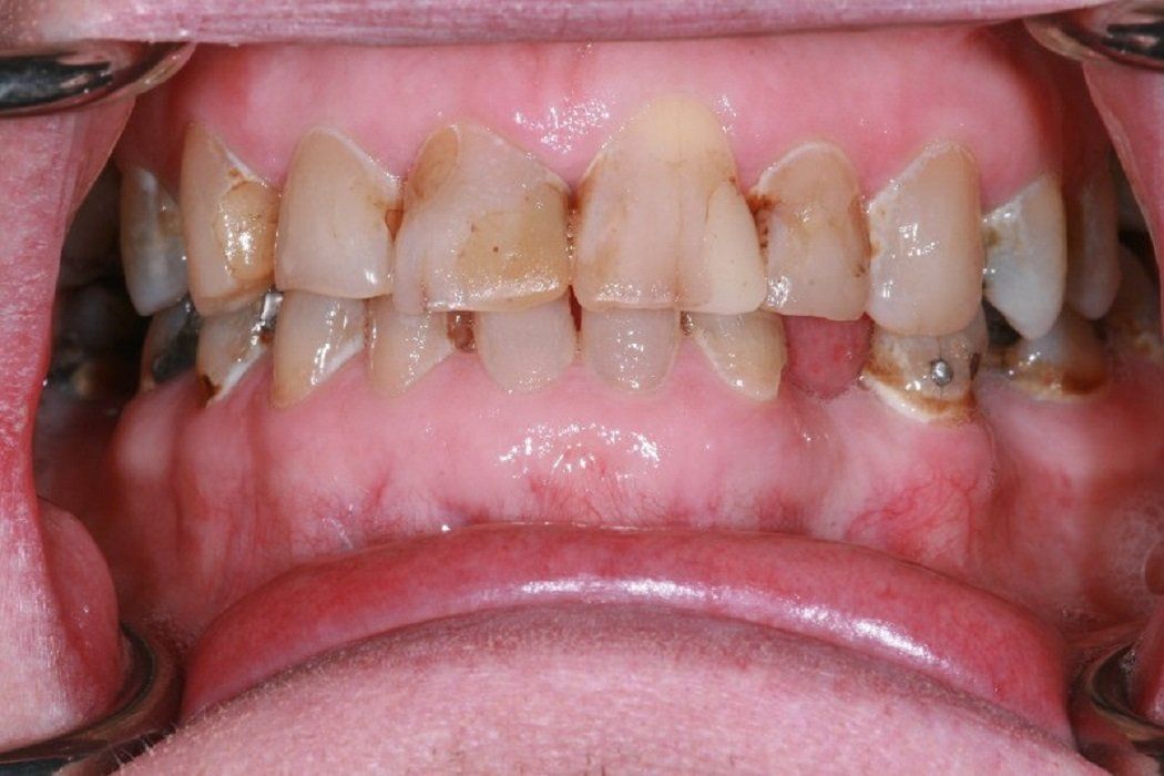 Before full mouth rehad with crowns and veneers