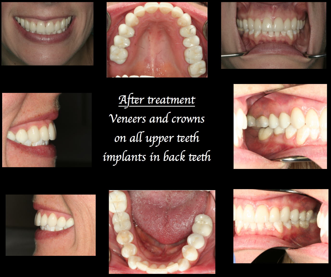 Veeners and crowns on all upper teeth and implants in back teeth