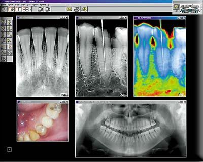digital x-ray dental x-ray Saugus, MA
