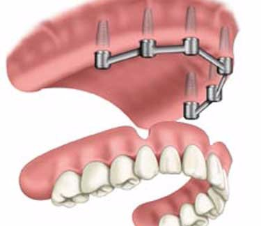 Implant Supported Dentures, Saugus, MA