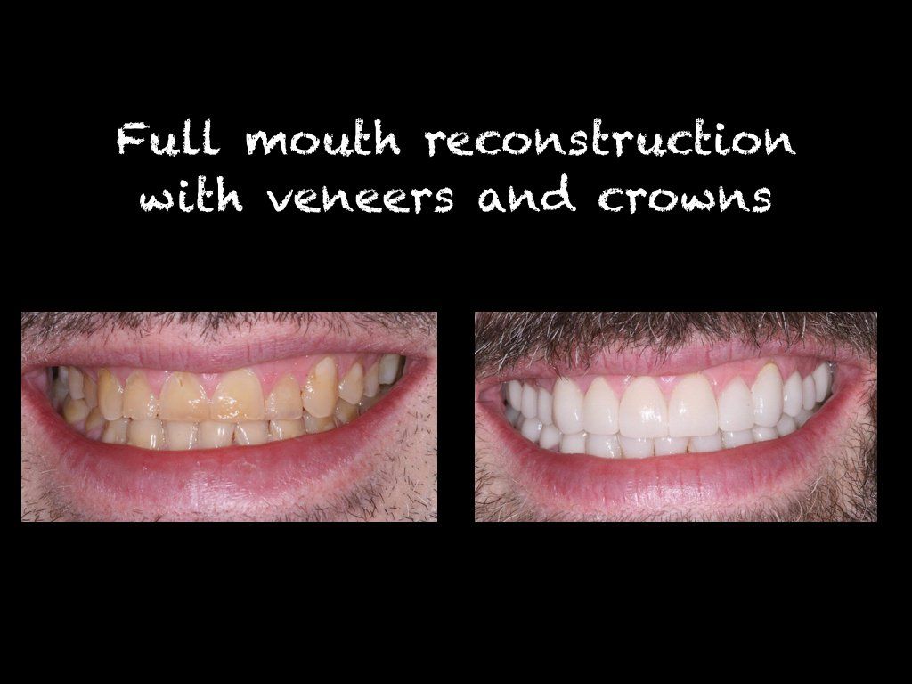 Full mouth reconstruction with veneers and crowns