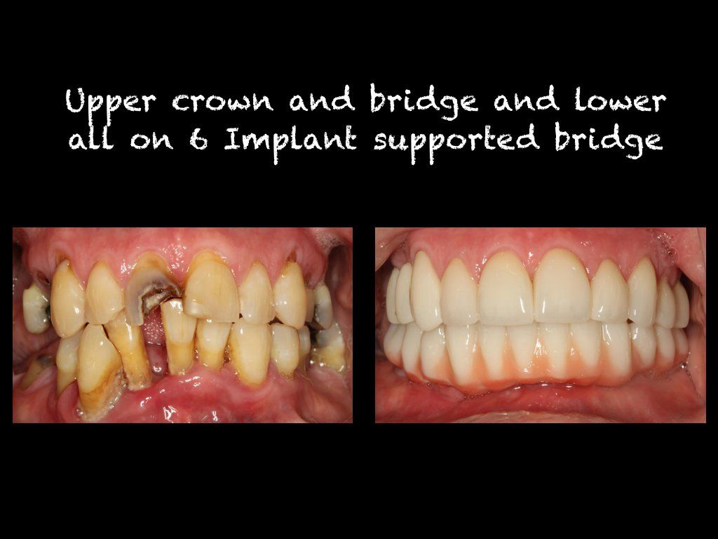 Upper  crown and bridge and lower  all on 6 implant supported bridge