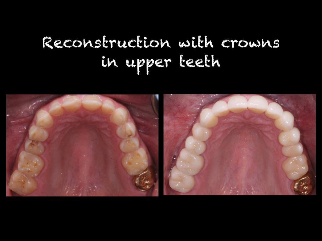 Reconstruction with crowns