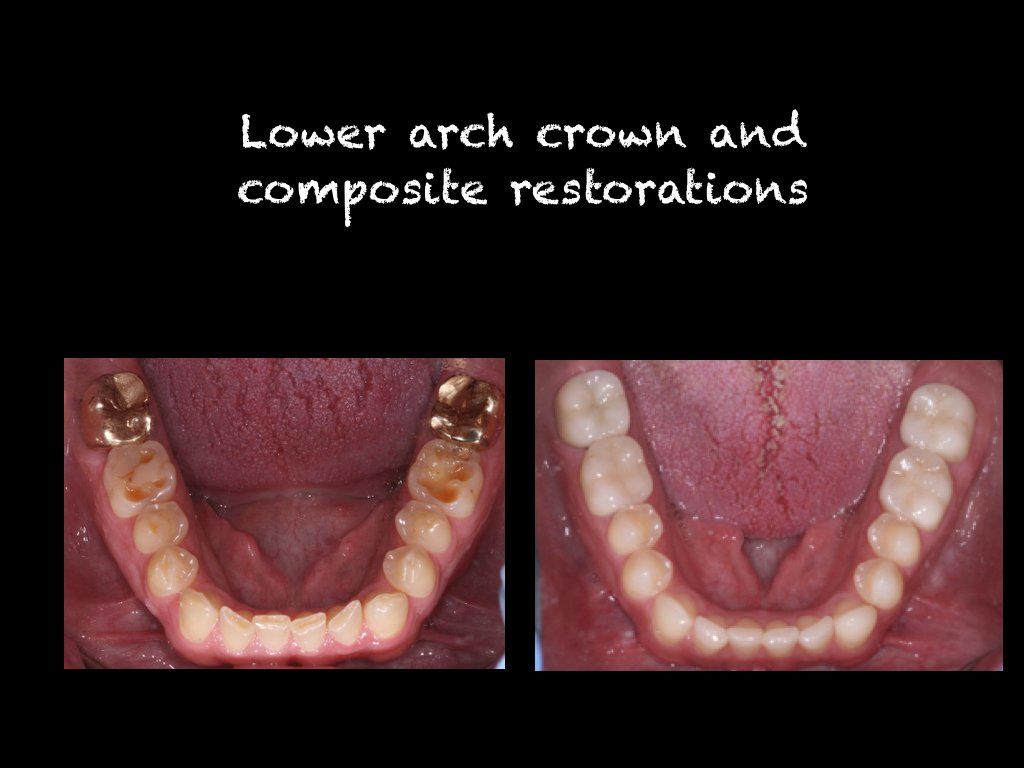 lower arch crown and composite restoration
