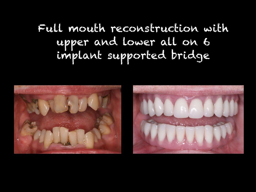 Full mount reconstruction with all on 6 implant supported bridge in upper  and lower arch