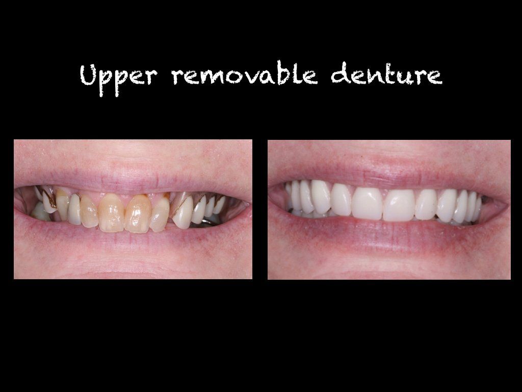Upper removable denture