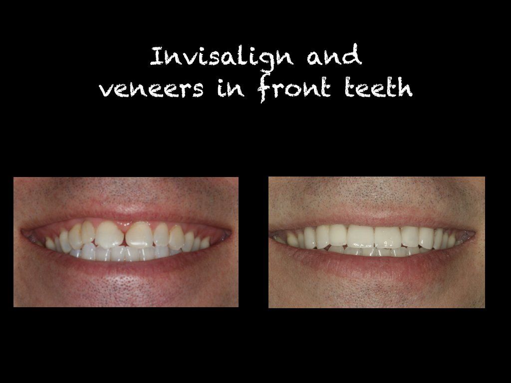 Invisalign and veneers in front teeth