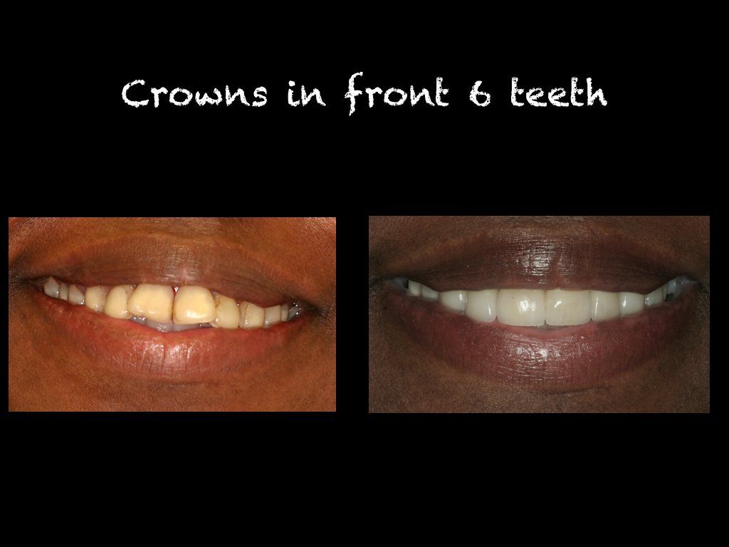 Crowns in front 6 teeth