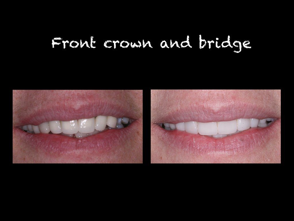 Front crown and bridge