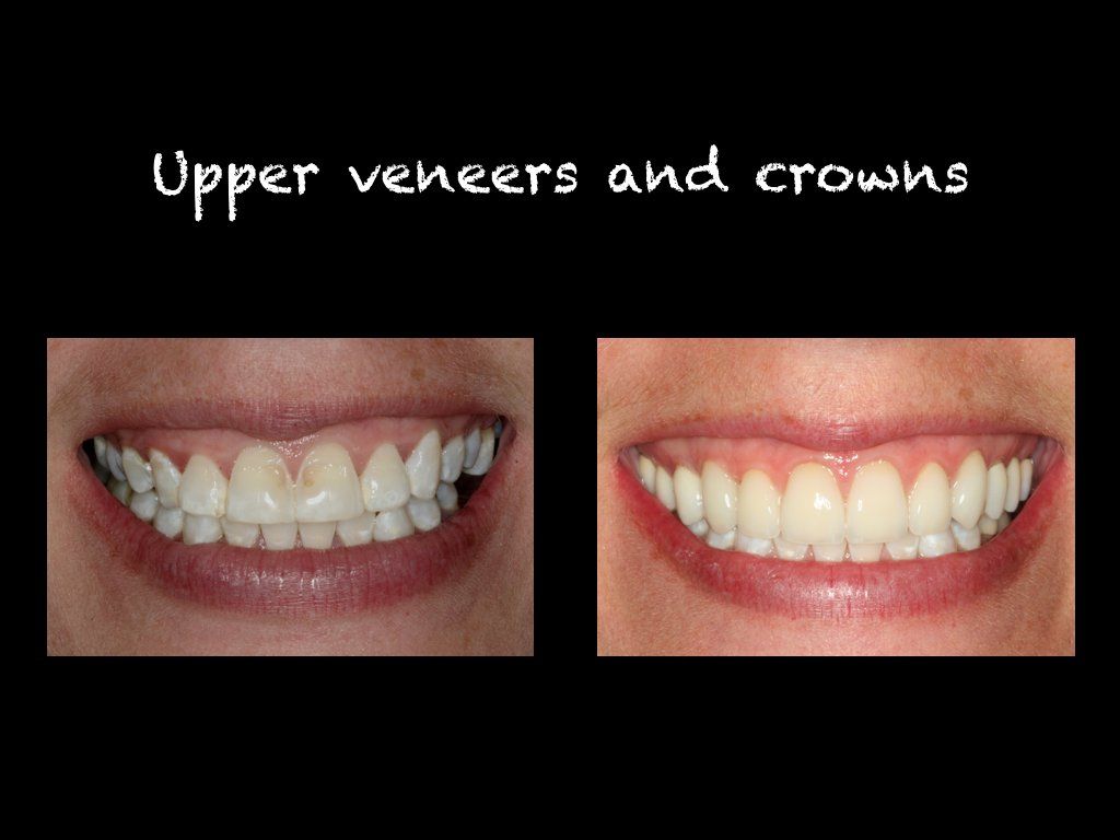 Upper veneers and crown